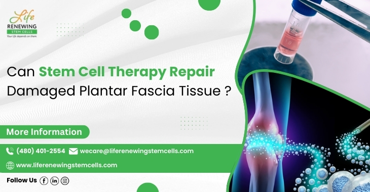 Can Stem Cell Therapy Repair Damaged Plantar Fascia Tissue?