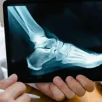 X-ray image of the foot and ankle bones displayed on a tablet for evaluating tendon injuries and treatment options.