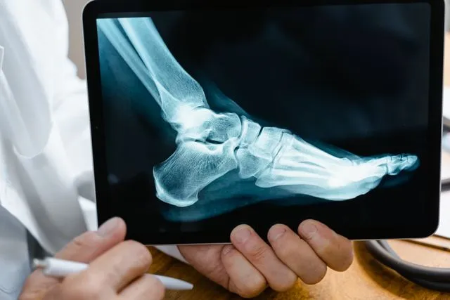 X-ray image of the foot and ankle bones displayed on a tablet for evaluating tendon injuries and treatment options.